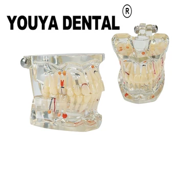 Прозрачен зъбен имплант Патология Модел на преподаване Модел за стоматолог Обучение на студенти по дентална медицина Изучаване на стоматологично оборудване